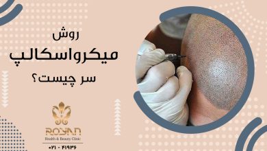 کاشت مو به روش میکرواسکالپ