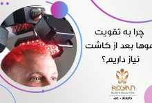 تقویت موها بعد از کاشت مو