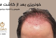 خونریزی بعد از کاشت مو