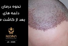 نحوه درمان دلمه های بعد از کاشت مو