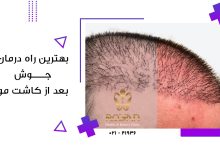 بهترین راه درمان جوش بعد از کاشت مو