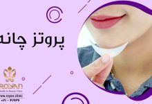 پروتز چانه