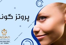 آشنایی با انواع روش های پروتز گونه