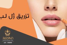 تزریق ژل لب