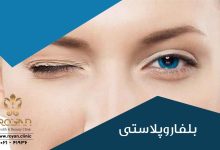 بلفاروپلاستی