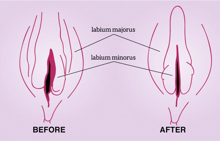 قبل و بعد از تزریق فیلر به واژن