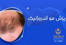 ریزش موی آندروژنیک
