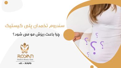 سندرم تخمدان پلی کیستیک