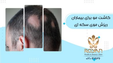 کاشت مو برای بیماران مبتلا به ریزش سکه ای