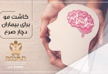 کاشت مو صرع