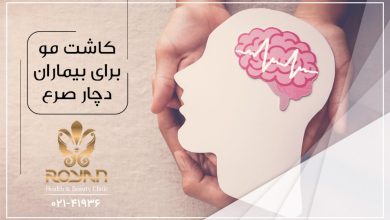 کاشت مو صرع