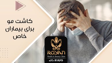 کاشت مو برای بیماران خاص