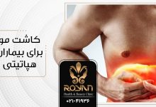 کاشت مو برای بیماران هپاتیتی