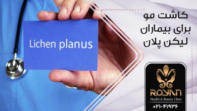 کاشت مو برای بیماران لینکن پلان