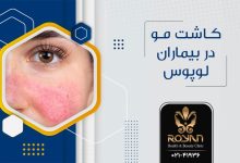 کاشت مو برای بیماران لوپوس