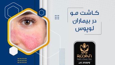 کاشت مو برای بیماران لوپوس