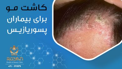 کاشت مو برای بیماران پسوریازیس