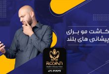 کاشت مو برای پیشانی های بلند