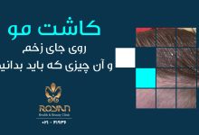 کاشت مو روی جای زخم