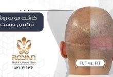 کاشت مو به روش ترکیبی