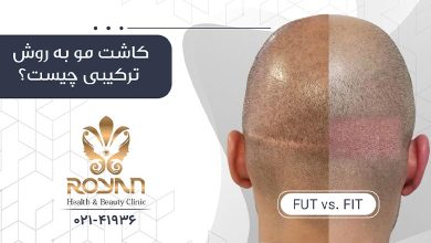 کاشت مو به روش ترکیبی