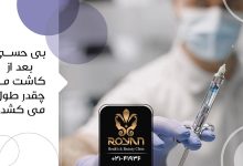 بی حسی بعد از کاشت مو