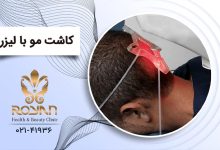 کاشت موی سر با لیزر