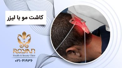 کاشت موی سر با لیزر
