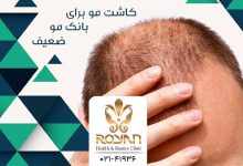 کاشت مو برای بانک موی ضعیف