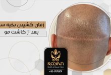 بخیه بعد از کاشت مو