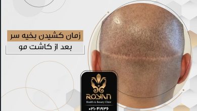 بخیه بعد از کاشت مو