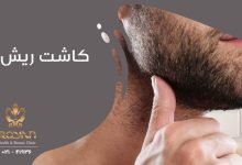 کاشت ریش