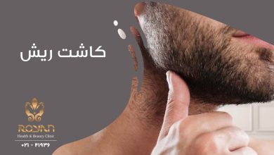 کاشت ریش