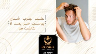 چرب شدن پوست سر بعد از کاشت مو