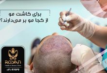 کاشت موی طبیعی
