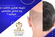 کاشت مو بعد از 5 ماه
