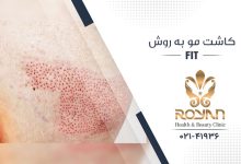 کاشت مو به روش FIT