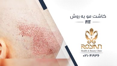 کاشت مو به روش FIT