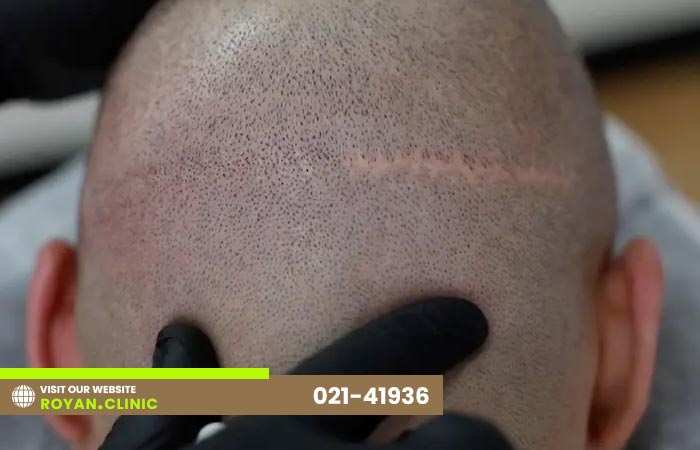 جای زخم بعد از کاشت مو به روش FUT