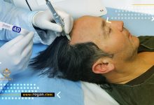 ترمیم مو به روش HRT