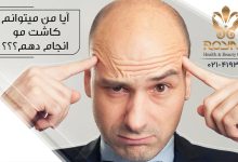 آیا من می توانم کاشت مو انجام دهم