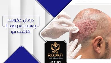 عفونت بعد از کاشت مو