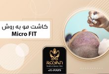 کاشت مو به روش میکرو FIT