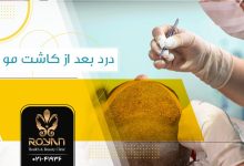 درد بعد از کاشت مو