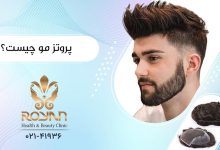 پروتز مو چیست ؟