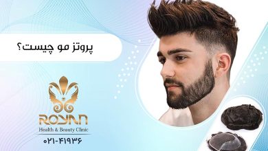 پروتز مو چیست ؟
