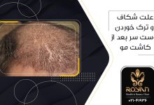 شکاف سر بعد از کاشت مو