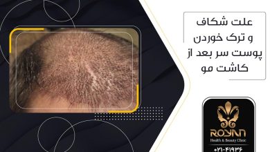 شکاف سر بعد از کاشت مو