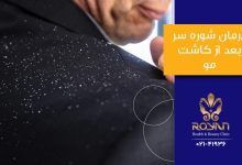 شوره بعد از کاشت مو