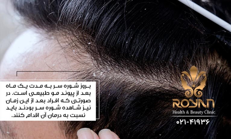 شوره سر بعد از کاشت مو طبیعی است